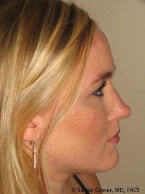 Rhinoplasty Before and After 25 | Sanjay Grover MD FACS