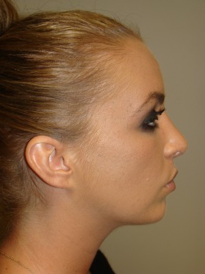 Rhinoplasty Before and After 24 | Sanjay Grover MD FACS