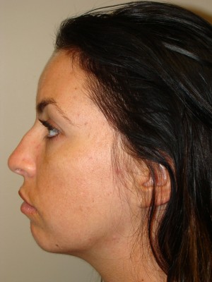Rhinoplasty Before and After 24 | Grover Aesthetics