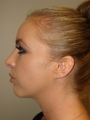 Rhinoplasty Before and After 24 | Grover Aesthetics