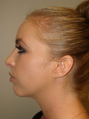 Rhinoplasty Before and After 24 | Sanjay Grover MD FACS