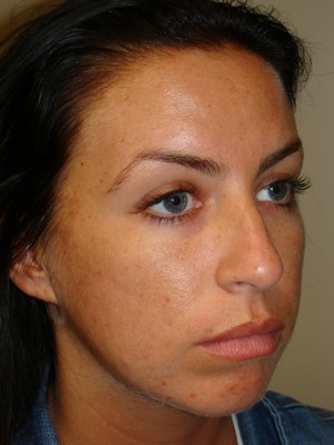 Rhinoplasty Before and After 24 | Grover Aesthetics