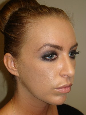 Rhinoplasty Before and After 24 | Grover Aesthetics