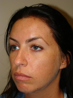Rhinoplasty Before and After 24 | Grover Aesthetics