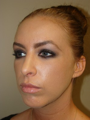 Rhinoplasty Before and After 24 | Grover Aesthetics