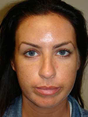 Rhinoplasty Before and After 24 | Grover Aesthetics