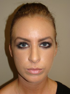 Rhinoplasty Before and After 24 | Grover Aesthetics