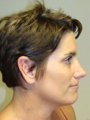 Rhinoplasty Before and After | Grover Aesthetics