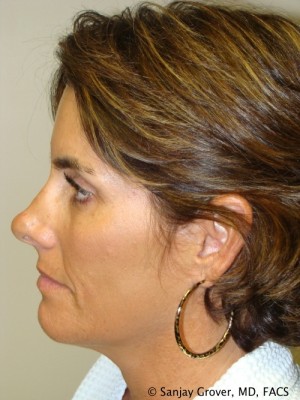 Rhinoplasty Before and After 25 | Grover Aesthetics