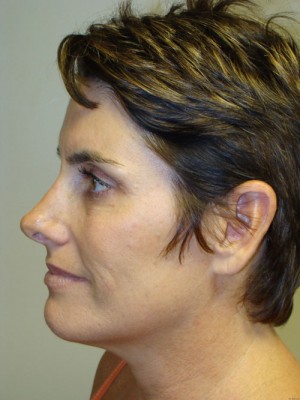 Rhinoplasty Before and After 25 | Grover Aesthetics