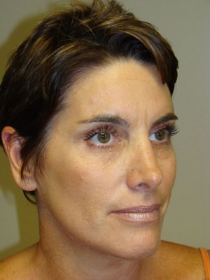 Rhinoplasty Before and After 25 | Grover Aesthetics