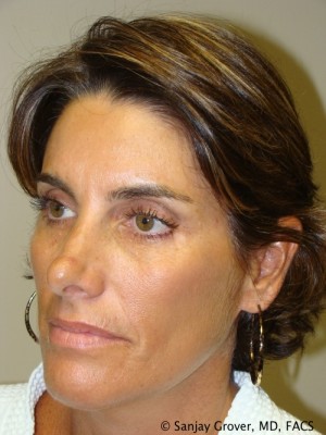 Rhinoplasty Before and After 25 | Grover Aesthetics