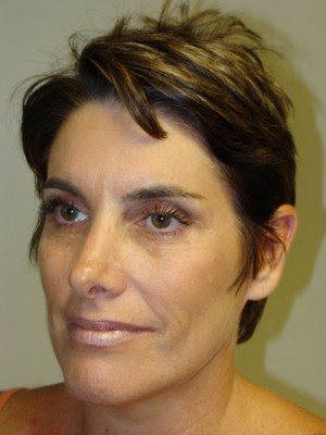 Rhinoplasty Before and After 25 | Grover Aesthetics