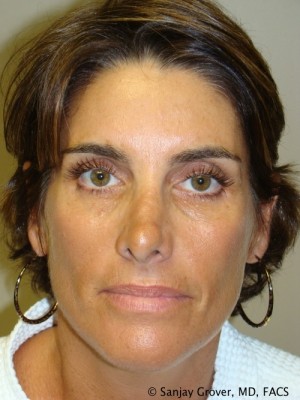 Rhinoplasty Before and After 25 | Grover Aesthetics