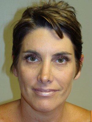 Rhinoplasty Before and After 25 | Grover Aesthetics