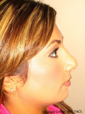 Rhinoplasty Before and After 15 | Sanjay Grover MD FACS