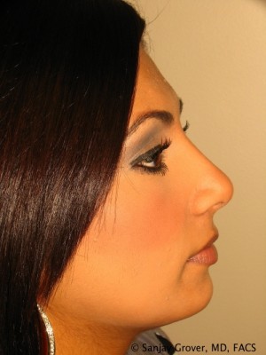 Rhinoplasty Before and After | Grover Aesthetics