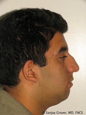 Rhinoplasty Before and After 37 | Sanjay Grover MD FACS