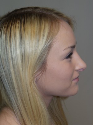 Rhinoplasty Before and After | Sanjay Grover MD FACS