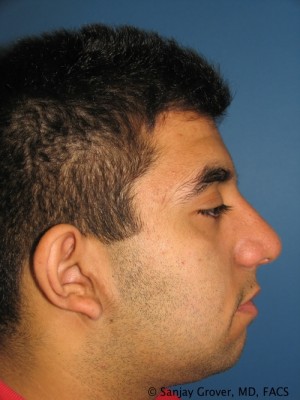 Rhinoplasty Before and After | Grover Aesthetics