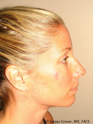 Rhinoplasty Before and After | Grover Aesthetics