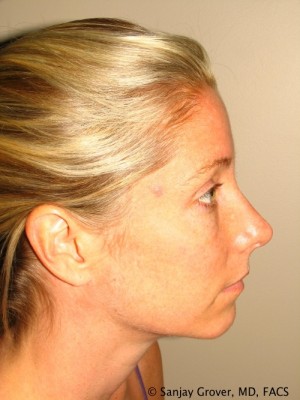 Rhinoplasty Before and After 28 | Sanjay Grover MD FACS