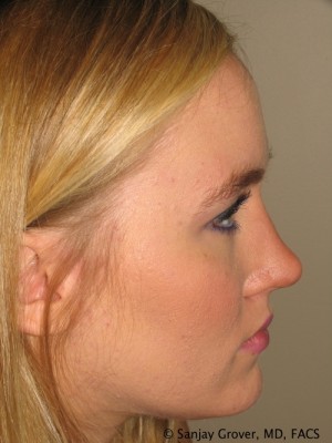 Rhinoplasty Before and After | Sanjay Grover MD FACS