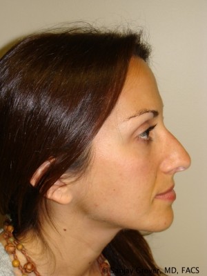 Rhinoplasty Before and After | Grover Aesthetics