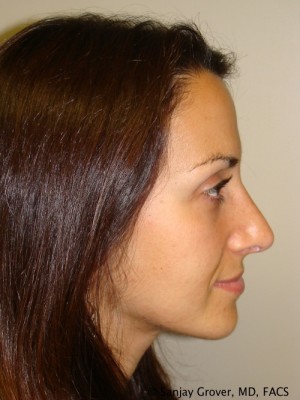 Rhinoplasty Before and After | Sanjay Grover MD FACS