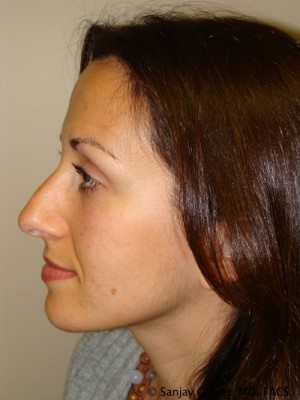 Rhinoplasty Before and After 30 | Sanjay Grover MD FACS