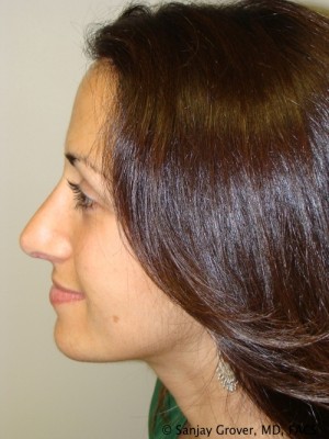 Rhinoplasty Before and After 30 | Grover Aesthetics
