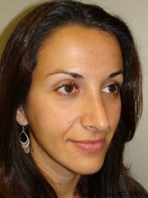 Rhinoplasty Before and After 30 | Grover Aesthetics