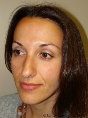 Rhinoplasty Before and After 30 | Grover Aesthetics