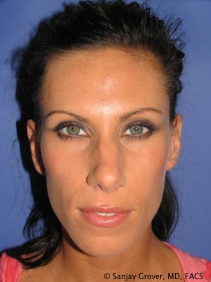 Rhinoplasty Before and After | Grover Aesthetics