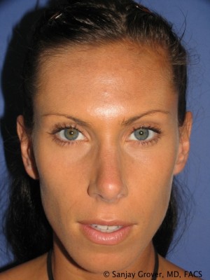 Rhinoplasty Before and After | Grover Aesthetics
