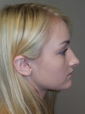 Rhinoplasty Before and After 13 | Sanjay Grover MD FACS