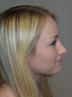 Rhinoplasty Before and After | Grover Aesthetics