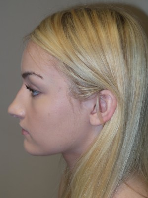 Rhinoplasty Before and After 32 | Sanjay Grover MD FACS