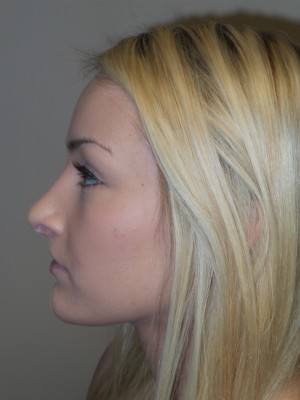 Rhinoplasty Before and After 32 | Sanjay Grover MD FACS