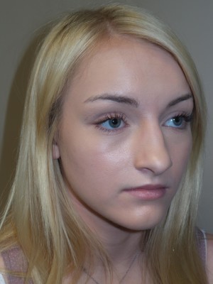 Rhinoplasty Before and After 32 | Grover Aesthetics