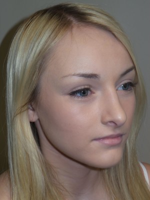 Rhinoplasty Before and After 32 | Grover Aesthetics
