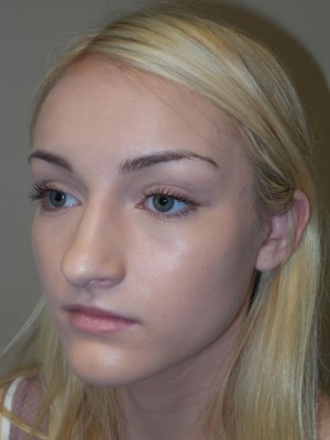 Rhinoplasty Before and After 32 | Grover Aesthetics