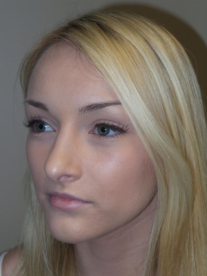 Rhinoplasty Before and After 32 | Grover Aesthetics