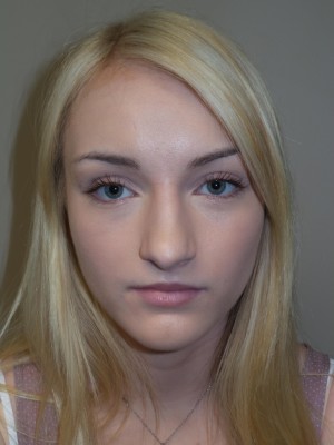 Rhinoplasty Before and After 32 | Grover Aesthetics