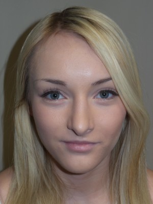 Rhinoplasty Before and After 32 | Grover Aesthetics