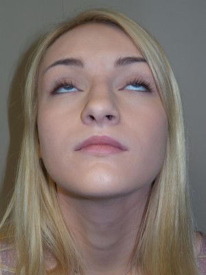 Rhinoplasty Before and After 32 | Grover Aesthetics