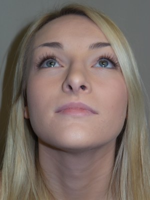 Rhinoplasty Before and After 32 | Grover Aesthetics
