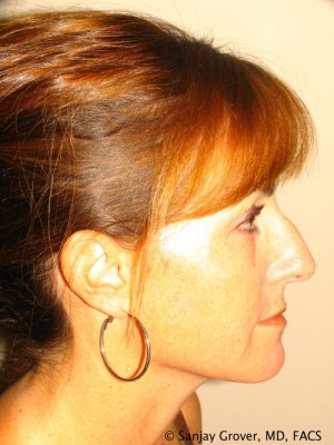 Rhinoplasty Before and After 38 | Sanjay Grover MD FACS