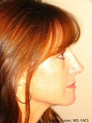 Rhinoplasty Before and After | Grover Aesthetics