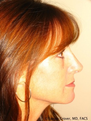 Rhinoplasty Before and After | Sanjay Grover MD FACS